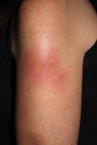 Cellulitis